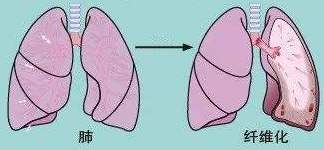 4 肺纤维化.jpeg